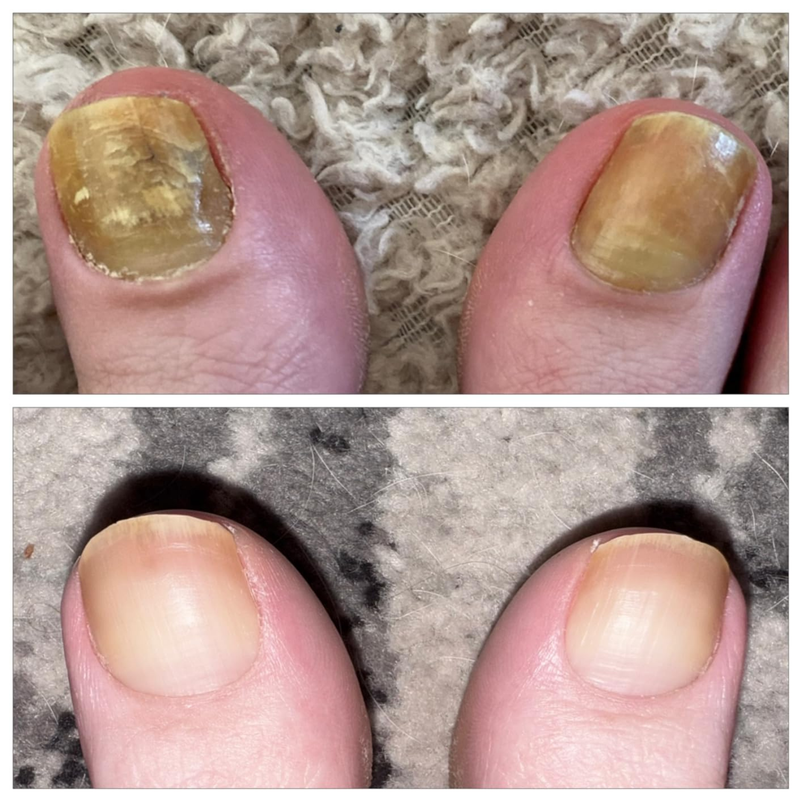 Before and after nail comparison